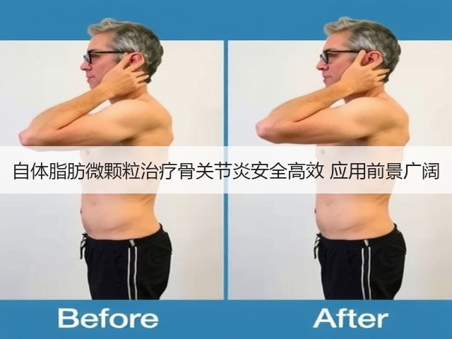 自体脂肪微颗粒治疗骨关节炎安全高效 应用前景广阔(图3)